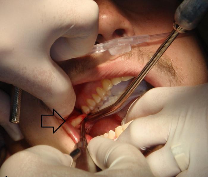 remoção do dente do siso nos efeitos da mandíbula superior 
